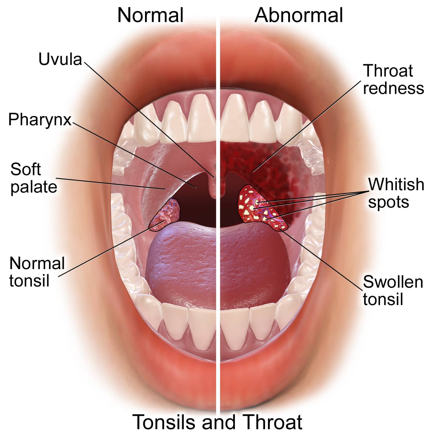 everything-about-strep-throat.jpg