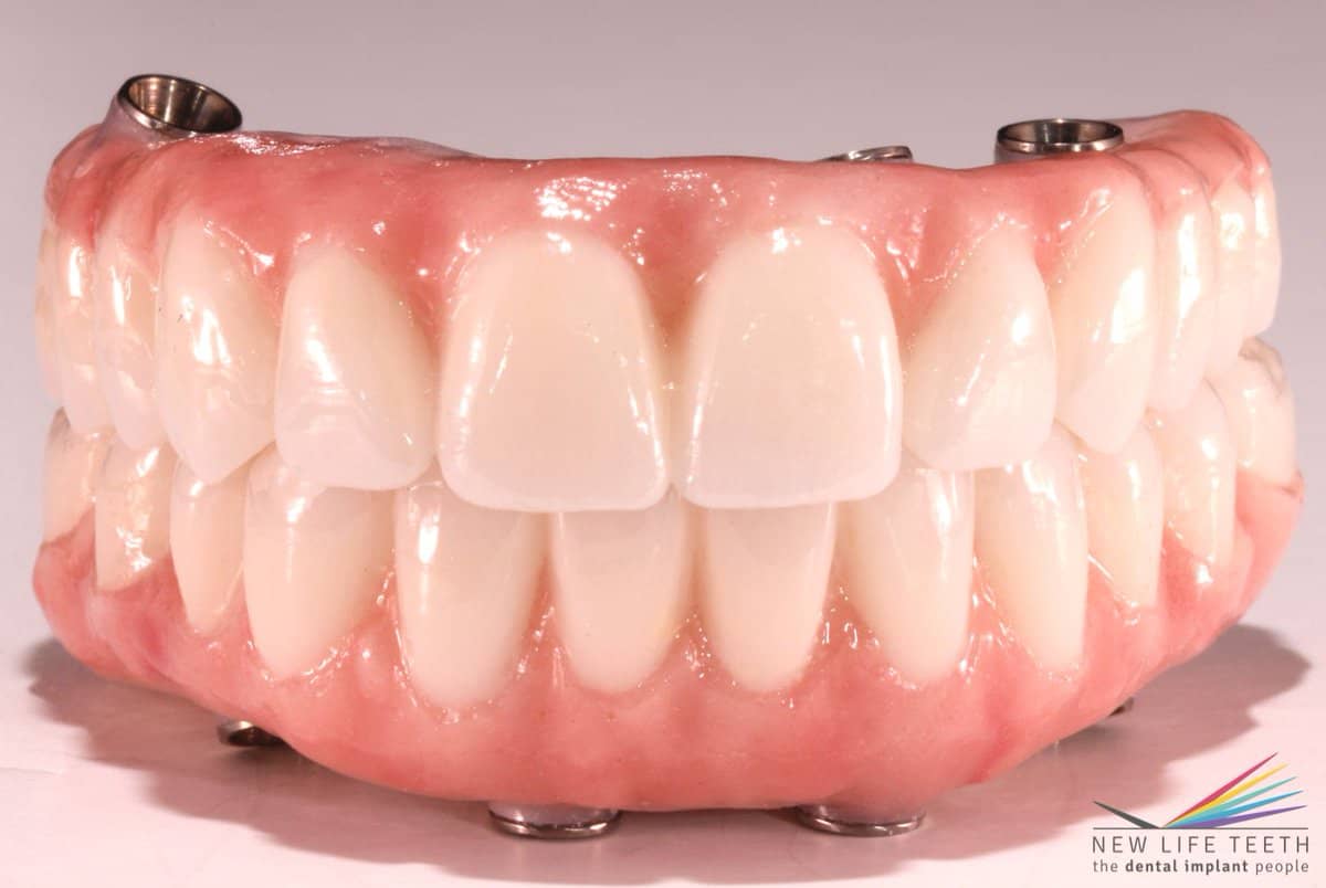 how-do-dentures-feel-and-look-like.jpg