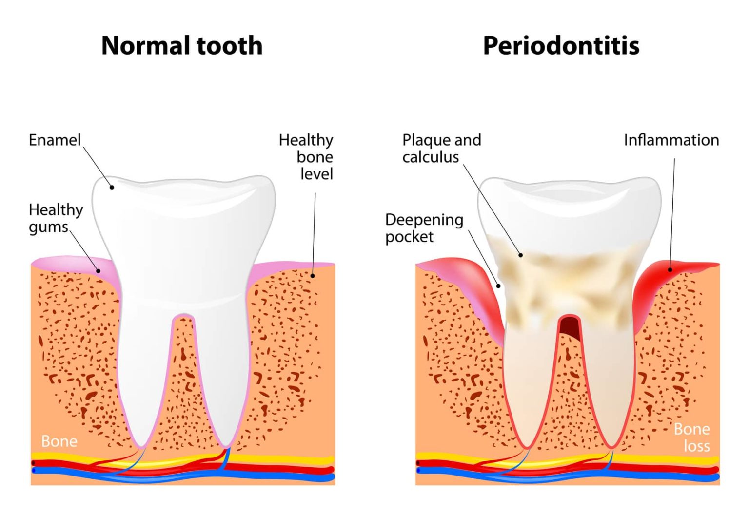 signs-of-gum-disease.jpg