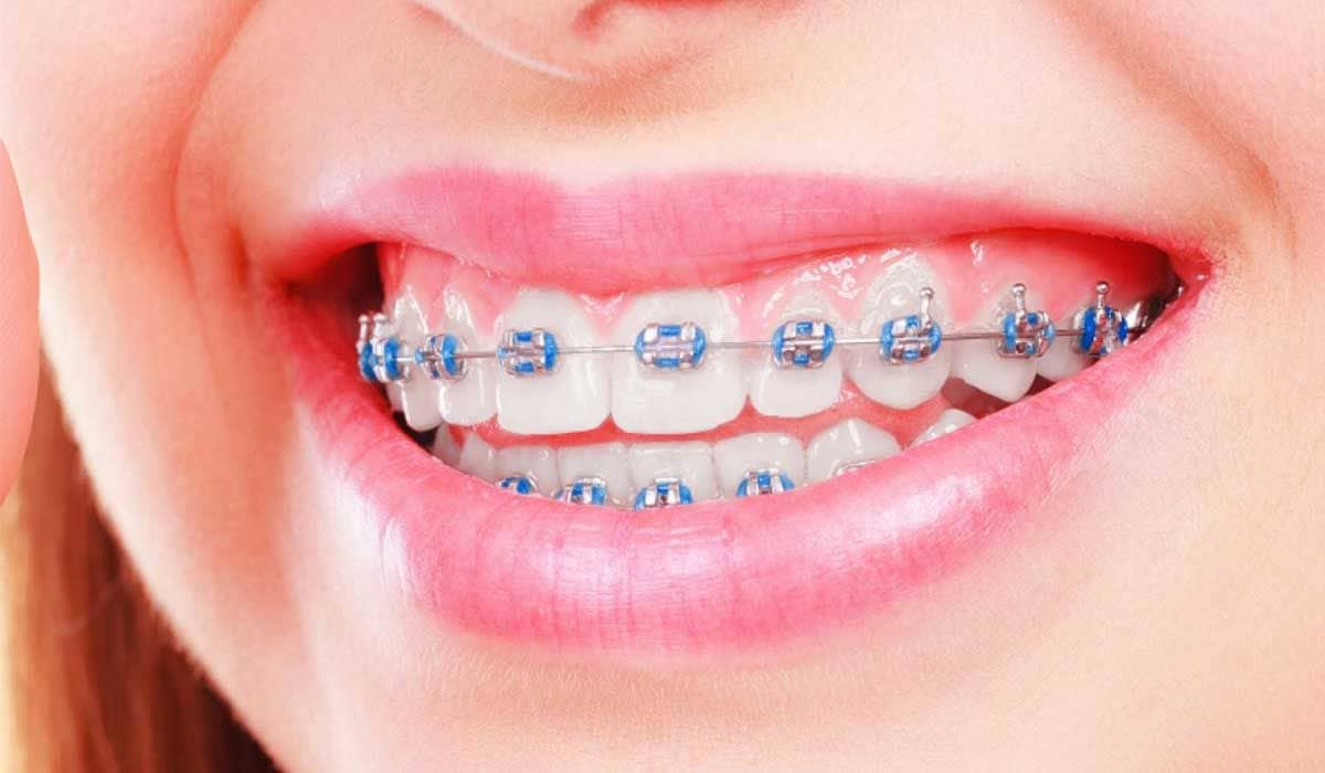 types-of-braces.jpg