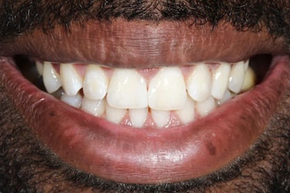 ben2-after-whitening-composite-bonding