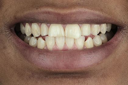 fatoumata1-before-zirconium-crowns