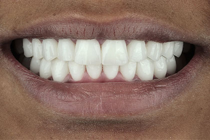 fatoumata2-after-zirconium-crowns