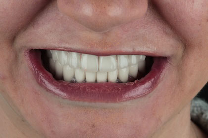 kayley2-after-hybrid-protheses-full-mouth-implants