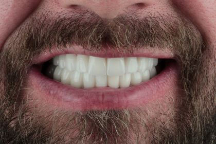 mark2-after-zirconium-crowns