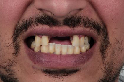 nabil1-before-zirconium-crowns