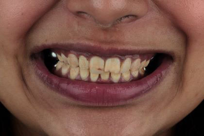 palwasha3-before-zirconium-crowns