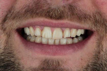 piotr1-before-zirconium-crowns