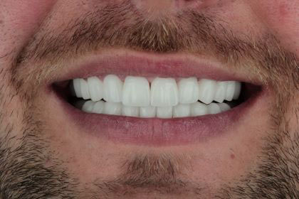 piotr2-after-zirconium-crowns