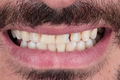 ramazan1-before-zirconium-crowns