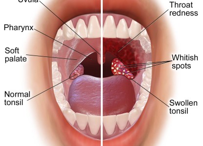 Everything About Strep Throat