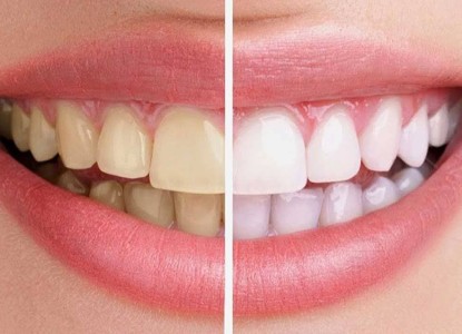 What to Expect Before a Teeth Whitening Procedure